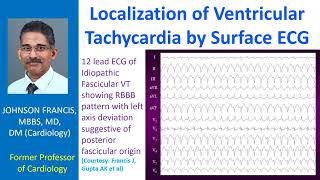 Localisation of Ventricular Tachycardia by Surface ECG [upl. by Goldia]