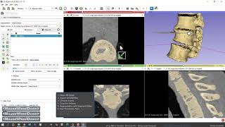 CT or MRI to 3D print DICOM to STL with Local computer Part 1 of 2 [upl. by Shulamith]