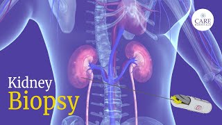 How is Kidney Biopsy Done  Kidney Biopsy Procedure  CARE Hospitals [upl. by Rexana]