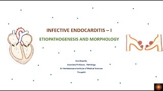 Infective endocarditis [upl. by Rosenstein141]