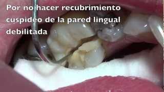 fractura dentaria [upl. by Harahs]