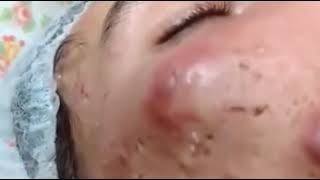 Big Acne Pus on face pop out Really hurt and terrified [upl. by Dominick852]