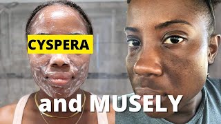 My Skincare Routine using Cyspera Cysteamine and The Musely Spot Cream [upl. by Saidnac]