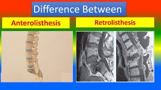 Difference Between Anterolisthesis and Retrolisthesis [upl. by Ress]