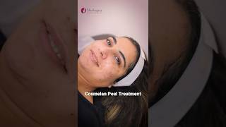 Cosmelan Peel Treatment  Before and After  Pigmentation Treatment in Noida  Skinlogics Clinic [upl. by Adai]