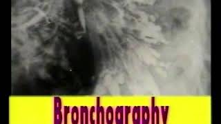 34 Bronchiectasis  Chest XRays  Dr Vaidya [upl. by Bonina]