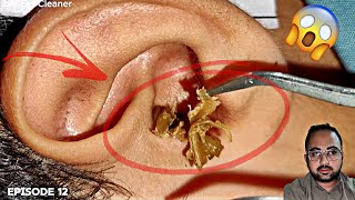 Biggest Ear wax Removal Satisfying  Ear Cleaner  Ear wax Removal  Episode 12 [upl. by Phineas]