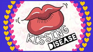 Infectious mononucleosis Kissing disease Diagnosis Clinical feature Treatment [upl. by Osborn]