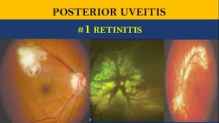 POSTERIOR UVEITIS  retinitis vs choroiditis [upl. by Nappie989]