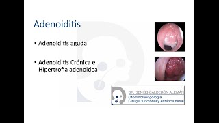 4 Adenoiditis [upl. by Randee]