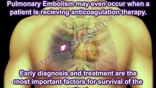 Deep venous thrombosPulmonary Embolism  Everything You Need To Know  Dr Nabil Ebraheim [upl. by Noleta87]