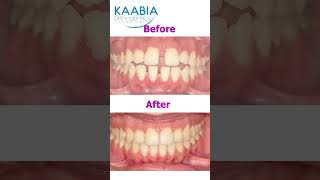 Bimaxillary protrusion  open bite and diastema [upl. by Gauldin]