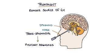 Understanding Acromegaly [upl. by Aynotak]