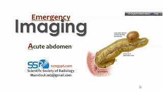 3 Acute Abdomen  ProfMamdouh mahfouz 2019 edition [upl. by Hurlbut]