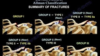 Clavicle Fractures Classification  Everything You Need To Know  Dr Nabil Ebraheim [upl. by Adnarom]