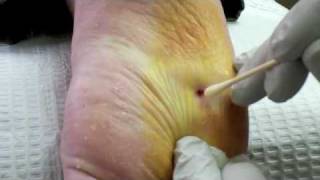 Surgical Plantar Wart Removal [upl. by Leodora]