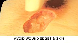 Enzymatic Debridement Demonstration Understand Wound Care [upl. by Amairam]