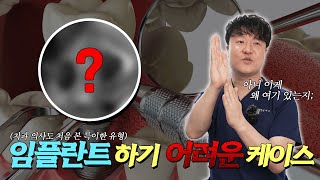 임플란트 수술이 불가능한 경우도 있다  광주 임플란트 상무지구치과 [upl. by Ysor]