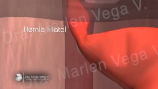 Dra Vega Cirugía de Hernia Hiatal – Video animado [upl. by Areval]