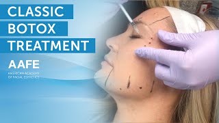 Full Face Botox Treatment  AAFE [upl. by Heise529]