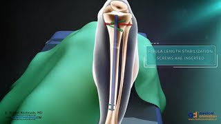 Precice Tibia Lengthening Surgical Animation [upl. by Flor]