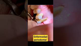 Enfermedad periodontal odontologia dentista sarro shorts [upl. by Klapp368]