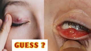 Stye or chalazion  explained indetail eyecareoptom eyelid infection lidproblems [upl. by Ailes]