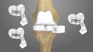 iTotal CR Total Knee Replacement Surgical Technique Animation  Conformis [upl. by Laehpar]