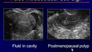 Sonography of the 1st Trimester Another Look [upl. by Merkley]