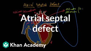 Atrial septal defect  Circulatory System and Disease  NCLEXRN  Khan Academy [upl. by Nauh446]