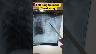 Left lung collapseleft fibro bronchiectasis chest x ray [upl. by Kotta]