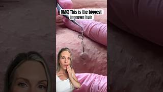 OMG THIS IS THE WORLDS BIGGEST INGROWN HAIR REMOVAL shorts [upl. by Enelyahs]