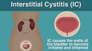 What Is  Interstitial Cystitis [upl. by Snook]