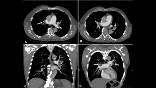 Angiografia pulmonar para TEP [upl. by Akinat839]