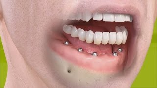 Straumann  Fixed restoration with 46 implants all straight [upl. by Samled236]