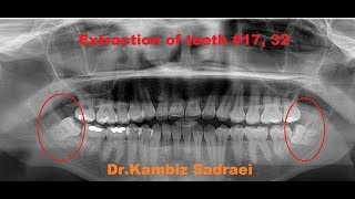 Extraction of Wisdom Teeth 17 amp 32 by DrKambiz Sadraei [upl. by Ahsoik]