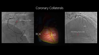 Coronary Collateral Circulation with Angiographic examples [upl. by Nivad]