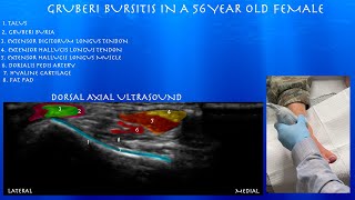 Ultrasound of a Gruberi Bursitis in a 56 Year Old Female by probeultrasound [upl. by Anerol]