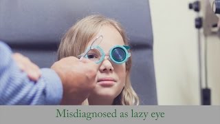 Misdiagnosed as Lazy Eye  Strabismus Treatment wo Surgery as Adult [upl. by Marys81]