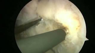 Arthroscopic Latarjet  BristowLatarjet Instability Shoulder System [upl. by Gnilrad]