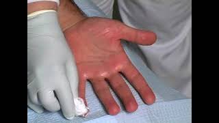 Botox for PALMAR Hyperhidrosis sweatypalms Dr David Pariser International Hyperhidrosis Society© [upl. by Nyrrat724]