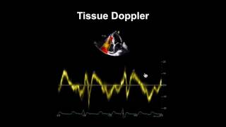 Echocardiography Essentials Evaluating right ventricular size and function [upl. by Ynnahc820]