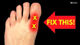 How to Fix BIG TOE Pain for Good [upl. by Sabina]