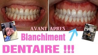 Blanchiment dentaire  AVANTAPRES Revue 25 [upl. by Niarfe]