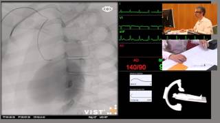 Mentice VIST®C  Catheterisation of the Right Coronary Artery From Right Radial Artery [upl. by Aenea]