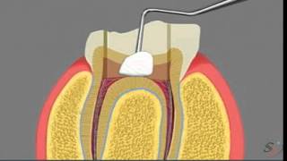 pulpotomy [upl. by Greenleaf]