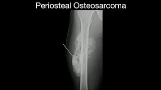 Periosteal Osteosarcoma [upl. by Celle595]