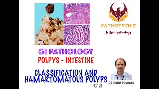 Intestinal Polyps  Classification and Hamartomatous Polyps [upl. by Eugilegna901]