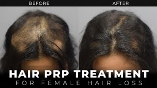 PRP Hair Treatment  Female Hair Loss  Trichotillomania Case Study [upl. by Aesoh]