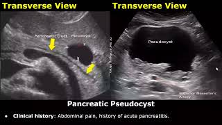 Pancreas Ultrasound Reporting  Diseases Scan Reports  How To Write USG Report  Abdominal USG [upl. by Iilek]